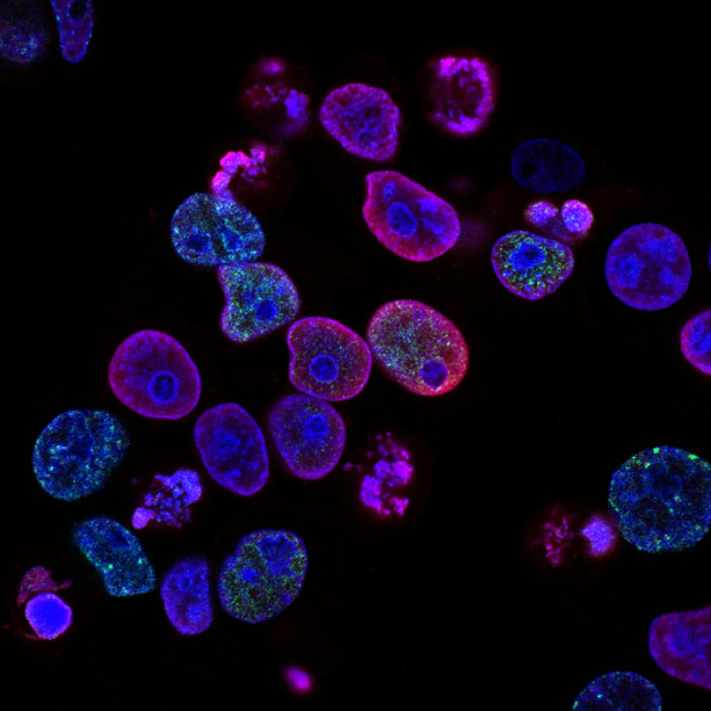 Fluorescence microscope image of human cancer cells, with nuclei stained blue and DNA damage markers highlighted in red and green. Images like this help researchers visualise how cancer cells respond — or fail to respond — to treatment at the molecular level. Photo: National Cancer Institute / Unsplash (free to use under the Unsplash License).