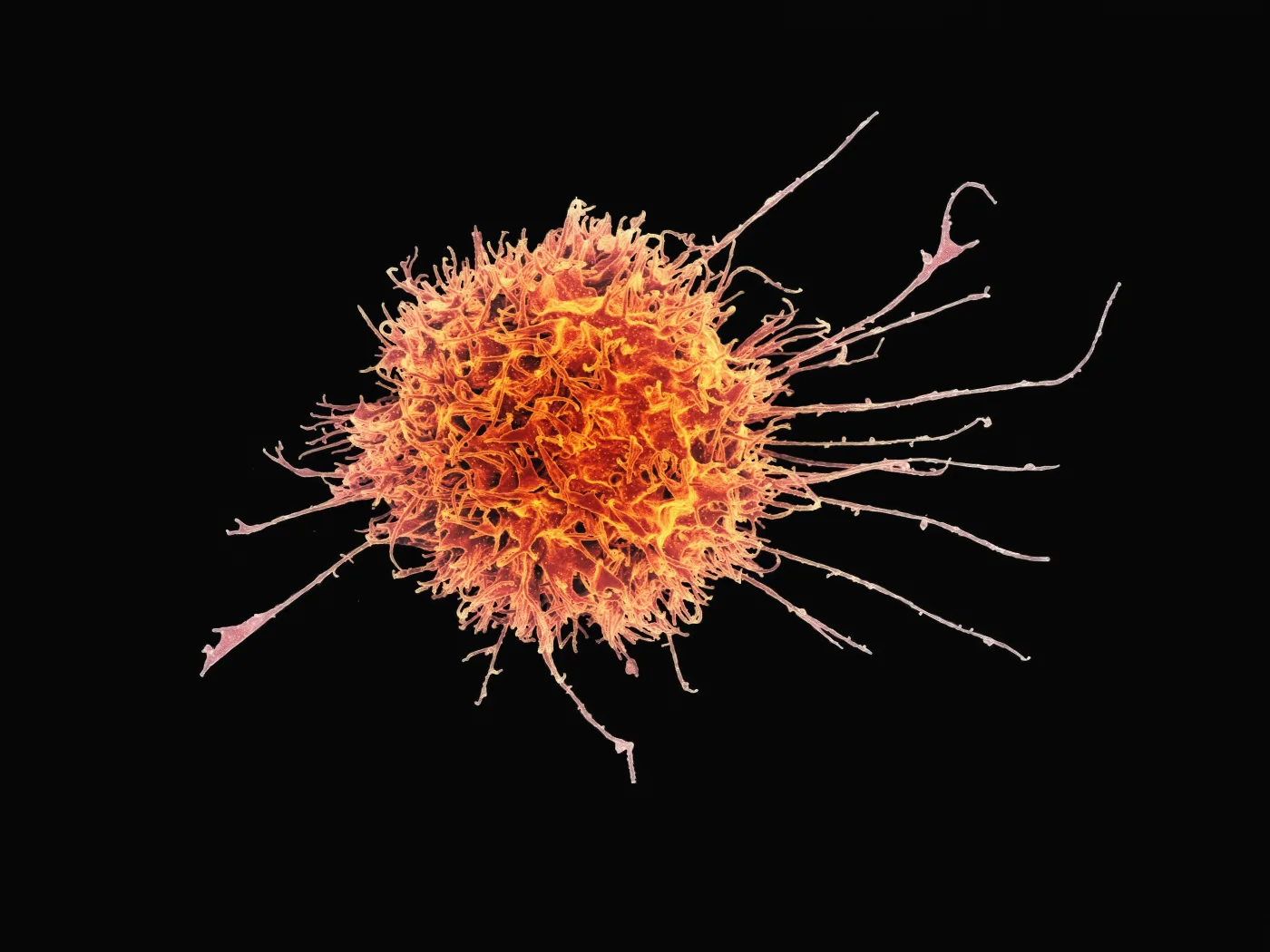 A colourised electron microscope view of a single cancer cell, its surface bristling with fibrous projections and long tendrils that help it grip, spread, and invade surrounding tissue. Each outgrowth is a clue to how cancer survives — and why scientists need new tools, like PerturbFate, to understand where the many genetic routes to resistance ultimately converge. Credit: Unsplash.